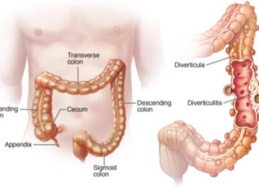 Diverticoli, Diverticolosi e Diverticolite