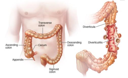 Diverticoli, Diverticolosi e Diverticolite