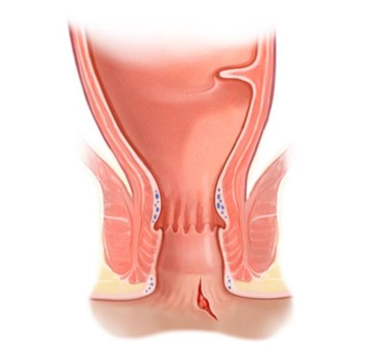 Proctologia - Ragade anale