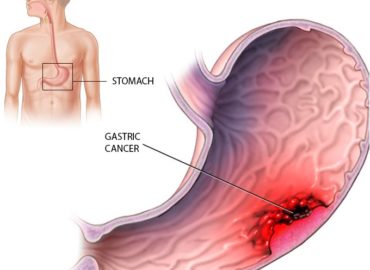 Tumore gastrico