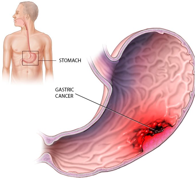 Tumore gastrico