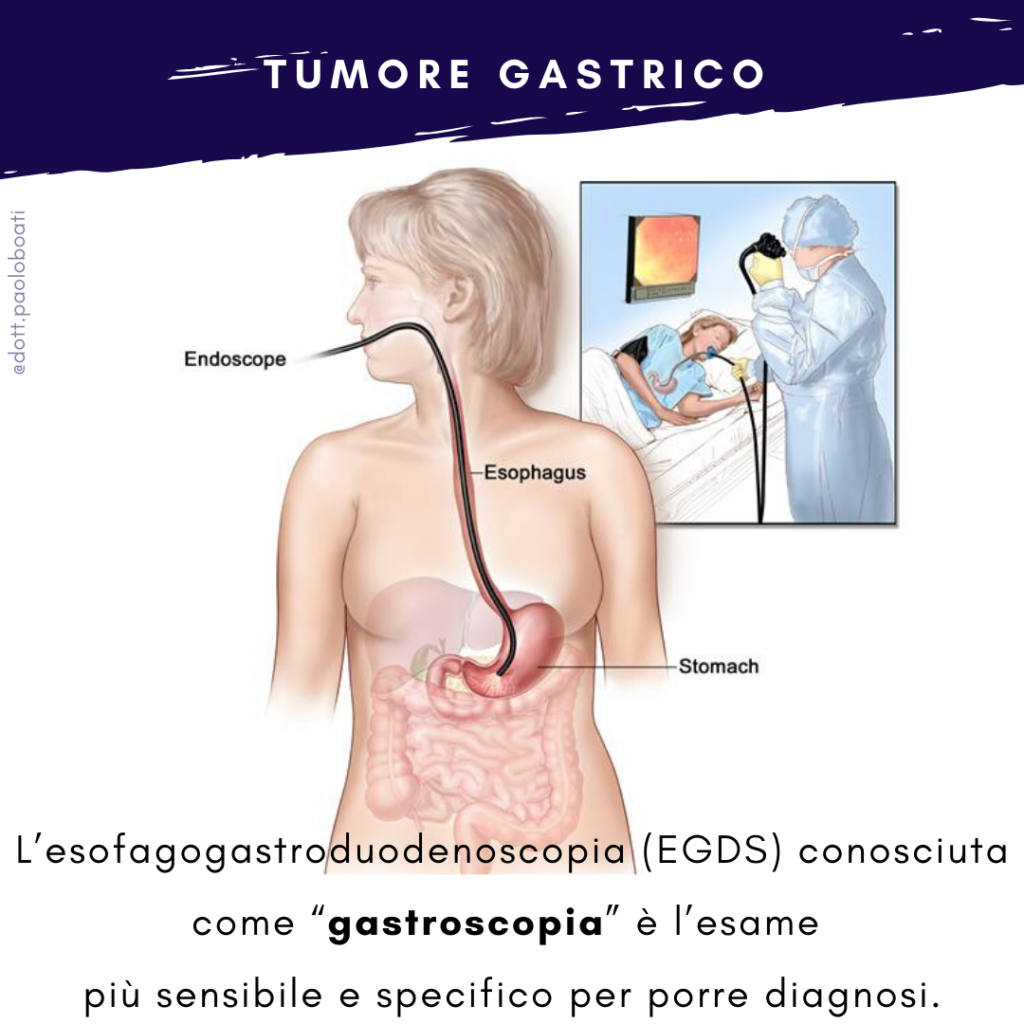 Tumore Dello Stomaco O Neoplasia Gastrica Dott Boati