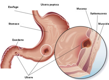 Ulcera peptica