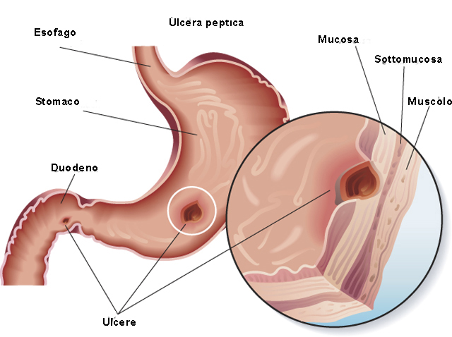 Ulcera peptica