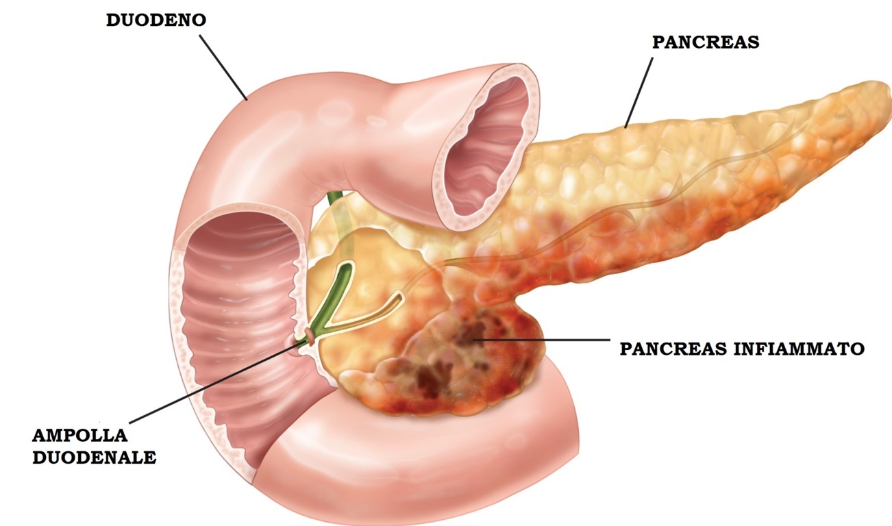 Pancreatite acuta