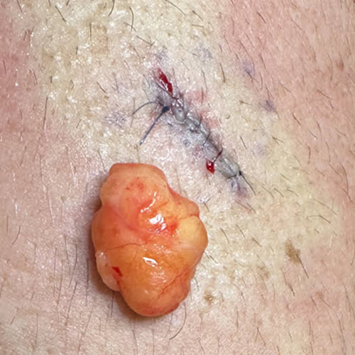 Immagine asportazione lipoma By dott Paolo Boati - Milano