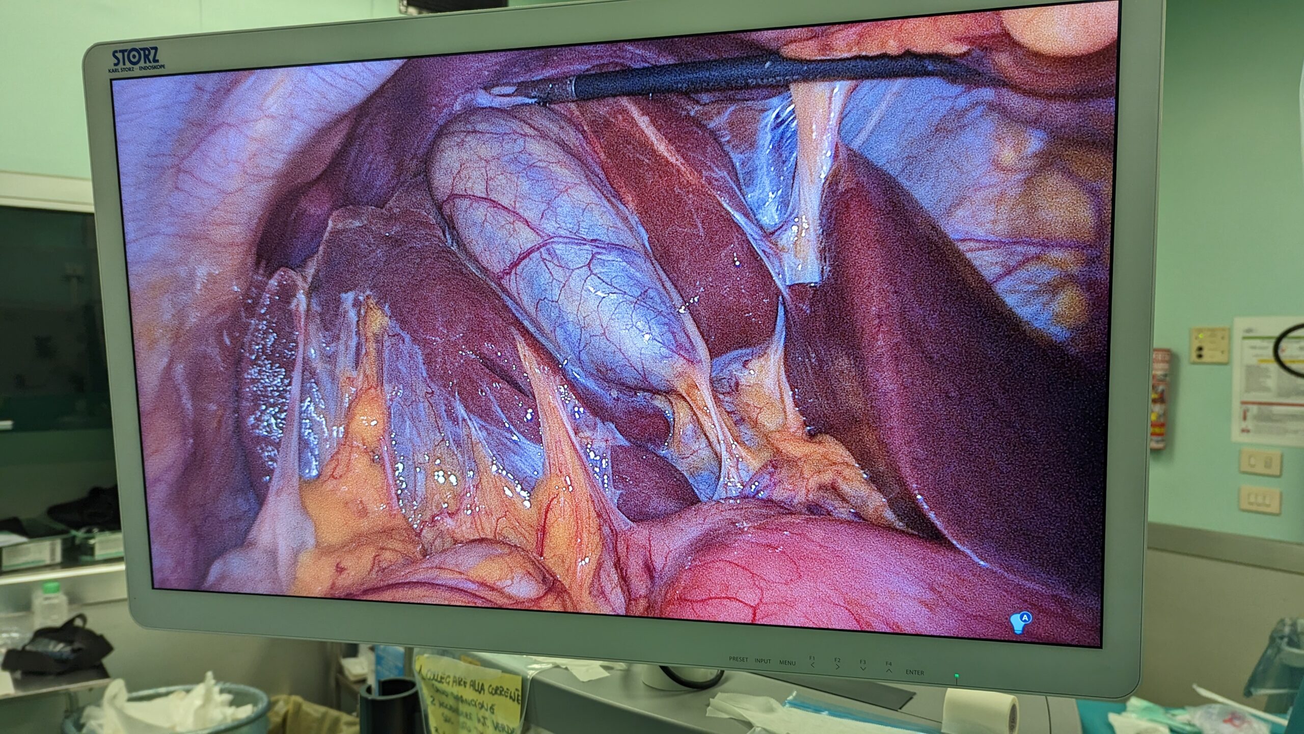 anatomia chirurgica colecisti