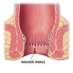 Ragade anale: illustrazione anatomica del canale anale