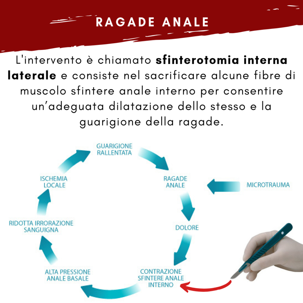 Chirurgia della ragade anale: trattamento chirurgico e sfinterotomia