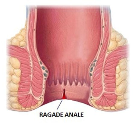 Ragade anale: illustrazione anatomica del canale anale