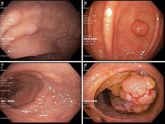 Tumore del colon | Dott Paolo Boati | Milano
