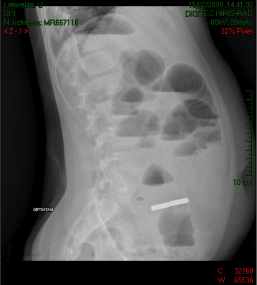 Immagine radiografica di occlusione intestinale dott Paolo Boati Chirurgia Milano