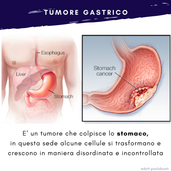 Localizzazione adenocarcinoma gastrico | Dott Paolo Boati | Chirurgo Generale | Milano