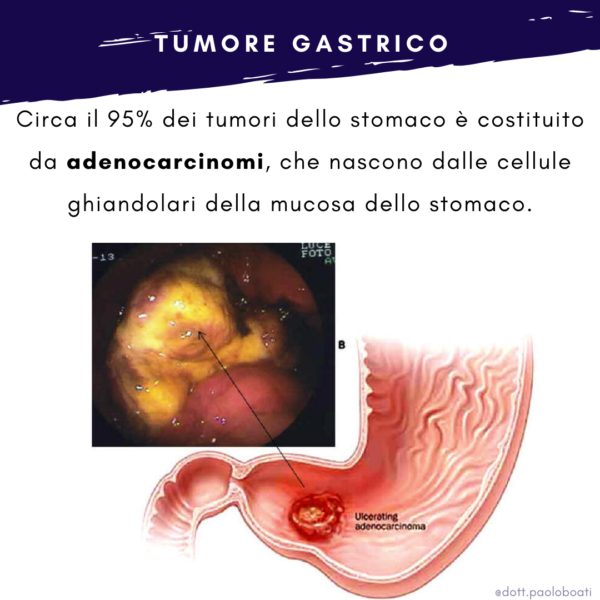 Adenocarcinoma gastrico | Dott Paolo Boati | Chirurgo Generale | Milano