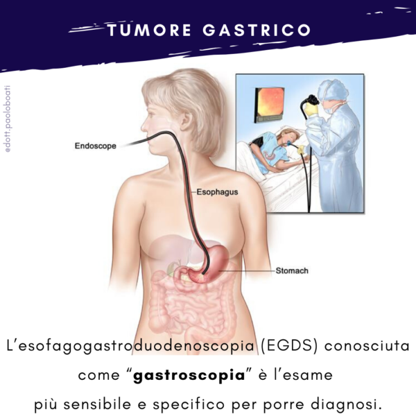 Gastroscopia per tumore gastrico  | Dott Paolo Boati | Chirurgo Generale | Milano