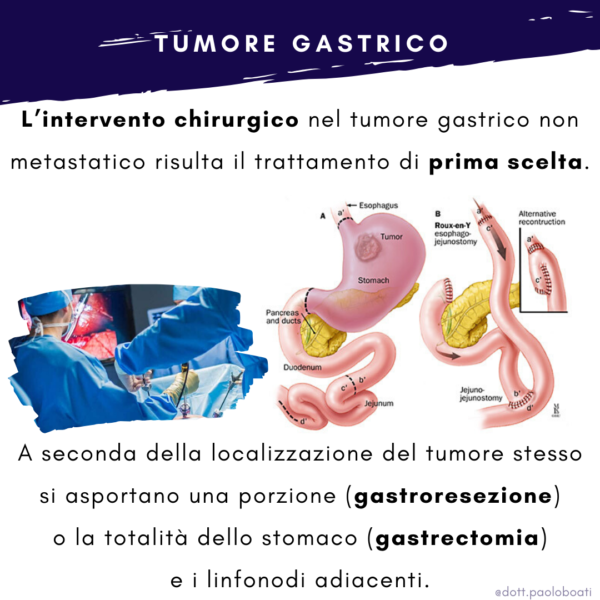 Intervento chirurgico per tumore dello stomaco  | Dott Paolo Boati | Chirurgo Generale | Milano