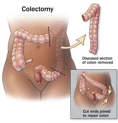 Emicolectomia per tumore del colon | Dott. Paolo Boati | Chirurgo Generale a Milano