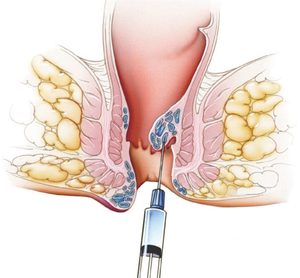 trattamenti proctologici ambulatoriali | scleroterapia