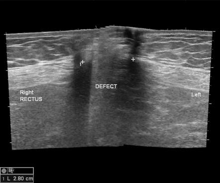 immagine ecografica di ernia | Dott Paolo Boati | Milano