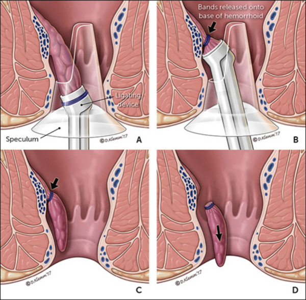 Proctologia ambulatoriale | Tecnica legatura elastica emorroidaria | Dott Paolo Boati Milano
